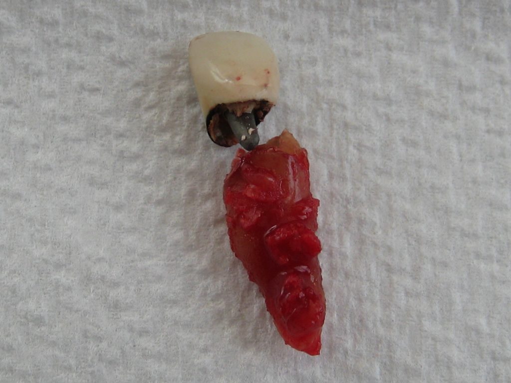 extracted root canal tooth