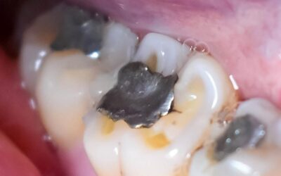 Protecting Patients from the Hidden Risks of Amalgam Fillings