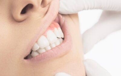 The Role of Biological Dentistry in Treating Gum Disease