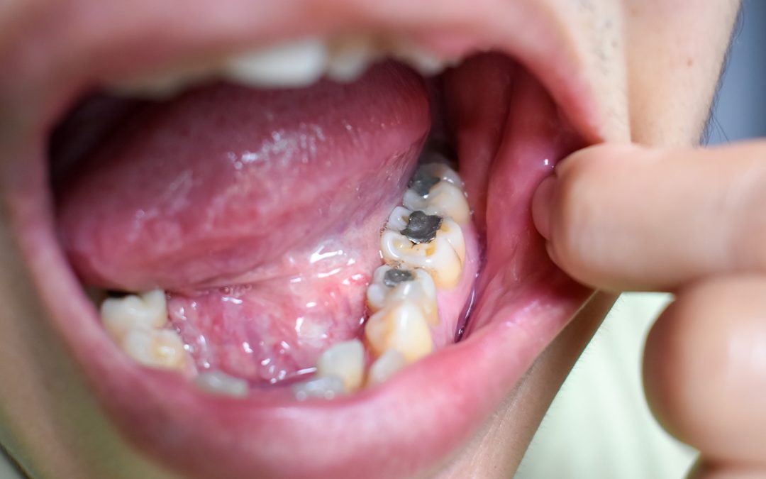 Why Biological Dentistry Offers Safer Solutions Than Mercury Fillings