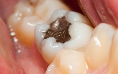 Why Biological Dentistry Recommends Avoiding Mercury Fillings