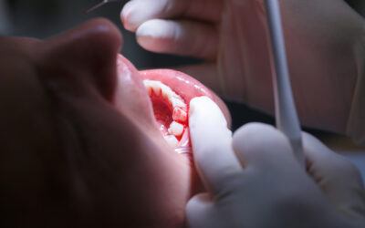 Understanding Root Canals Through the Lens of Biological Dentistry