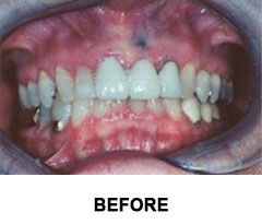 Constituents migrate out of the filling