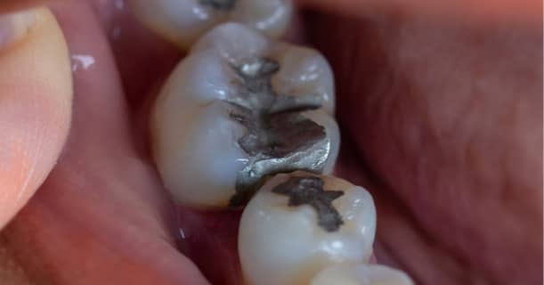 The Latest Scientific Review Research on Mercury Dental Amalgam & the Global Movement to “Make Mercury History for All”