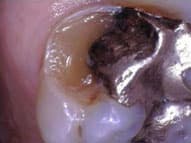 They expand over time and result in tooth breakage