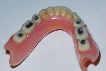 Mercury (Hg) Fillings Are Unsightly