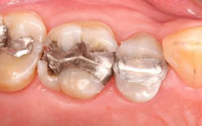 Alarming Findings on Mercury Dental Amalgam